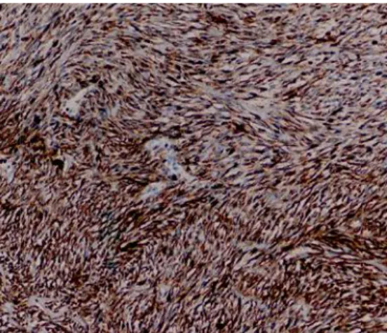 Gambar 7. Imunohistokimia pan-cytokeratin (AE 1/3) positif   pada sel-sel spindle(pembesaran 100x)