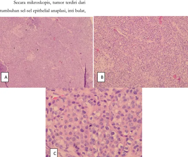 Gambar 14. Tampak sel-sel tumor dengan sitoplasma luas, inti eksentrik tersusun dalam lobulus-lobulus padat (A