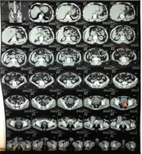 Gambar 2.  Tanda panah pada foto CT Scan 