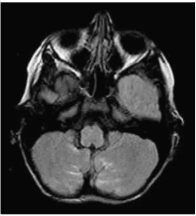 Gambar 1.  Magnetic resonance imaging (MRI) pasien dengan PRES. 10