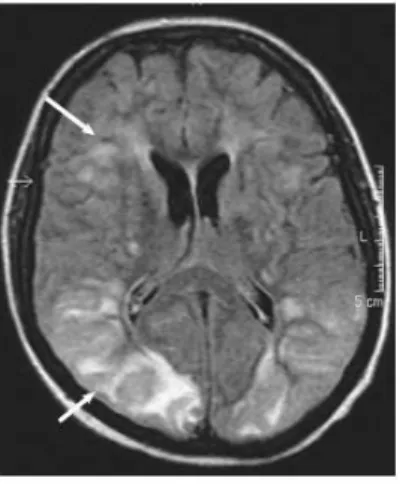 Gambar 2 Magnetic resonance imaging (MRI) pasien dengan ensefalopati uremik. 9