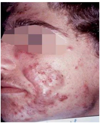 Gambar 2.6 Gradasi IV Akne vulgaris (Dikutip dari: http://emedicine.medscape.com/article/1069804-overview) 