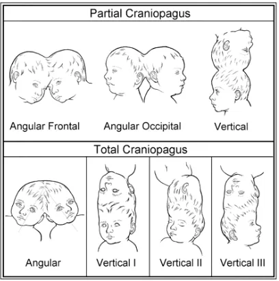Gambar 2.6 Tipe-tipe kraniopagus 