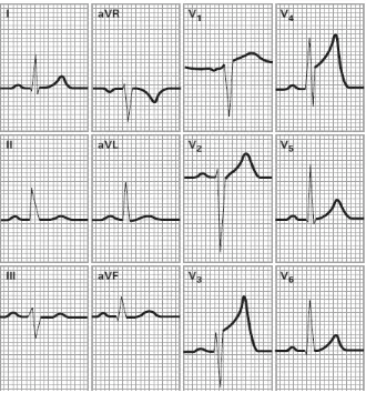 Gambar 2.4. Gambaran elektrokardiogram dari infark miokardium anterior (Jones,  2005)  