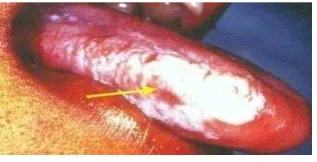 Gambar 2.4. Oral Hairy Leukoplakia 