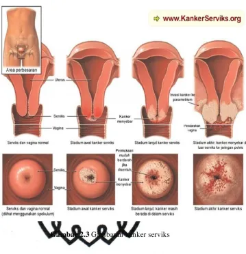 Gambar 2.3 Gambaran kanker serviks 