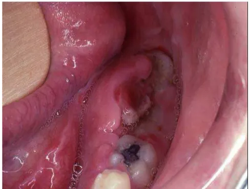 Gambar 3. Gambaran intra oral osteosarkoma mandibula yang terjadi pasca pencabutan gigi dan pada terlihat adanya oedem disertai pembengkakan (R