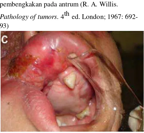 Gambar 5. Gambaran intra oral osteosarkoma maksila disertai dengan adanya massa tumor dan pada pembengkakan pada antrum (R