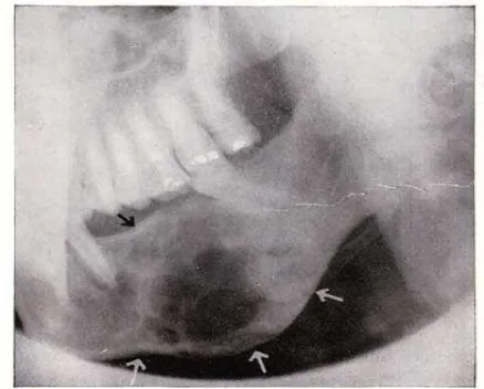 Gambar 7. Gambar radiografi osteosarkoma tipe osteolitik, dimana terlihat adanya perluasan kehancuran tulang dan adanya keteribatan tulang pada daerah mandibula (Mc