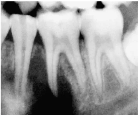 Gambar 9. Gambaran radiografi menunjukkan pelebaran ligament periodontal dan lamina dura osteogenic sarcoma of the jaws