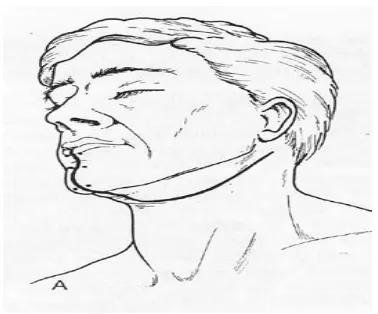 Gambar 13. Beberapa tipe reseksi mandibula. A. Reseksi marginal atau segemental mandibula dimana tidak mengganggu kontinuitas mandibula