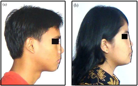 Gambar 14. Foto profil lateral wajah mahasiswa USU ras Deutro-Melayu       (a) Mahasiswa laki-laki (b) Mahasiswa perempuan