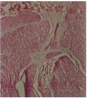Gambar 2.5.  Gambaran mikroskopis menggunakan pewarnaan hematoxylin dan eosin (H&E) kasus Hirschsprung’s disease (Abbas, et al., 2013)  