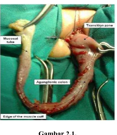 Gambar 2.2.  conventional laparoscopic pull-through