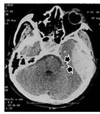 Gambar 5. CT scan pasien trauma kepala