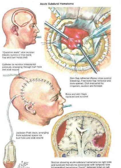 Gambar 6. Perdarahan kompleks intracranial (Sumber: Netter)