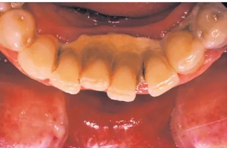 Gambar 2.6.1 b. Plak Subgingiva pada permukaan akar gigi yang telah diekstraksi 