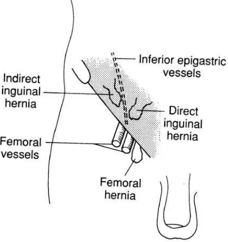 Gambar 1. Anatomis Hernia Inguinalis 