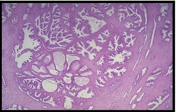 Gambar 2.3: Histopatologi BPH menunjukkan adanya terjadi pembesaran 