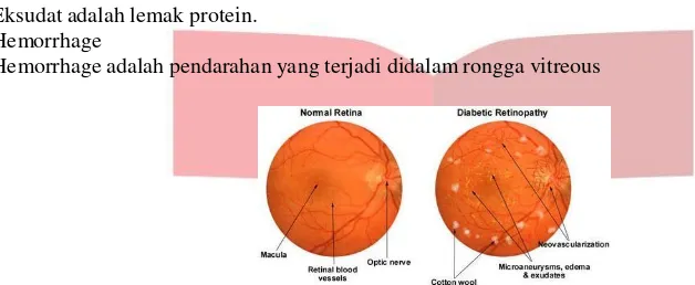 Gambar 1. Perbedaan retina normal dan retina pada penderita diabetes retinopati