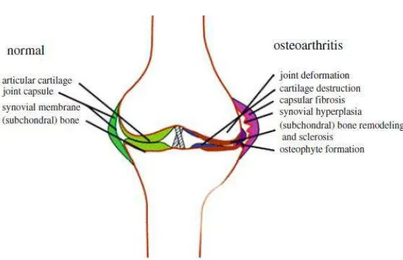 Gambar 1. Proses patologis yang terjadi pada osteoartritis lutut 