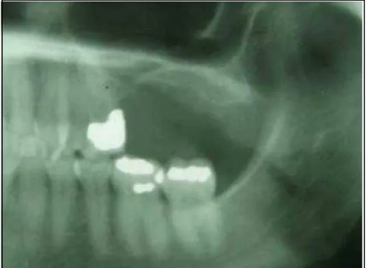 Gambar 4.  Tampilan radiografis bagian edentulus pada (Anonymus.<http://www.albertadentalimplans.com/imaregio posterior maksila yang akan dilakukan     pemasangan implan dengan teknik sinus lift up