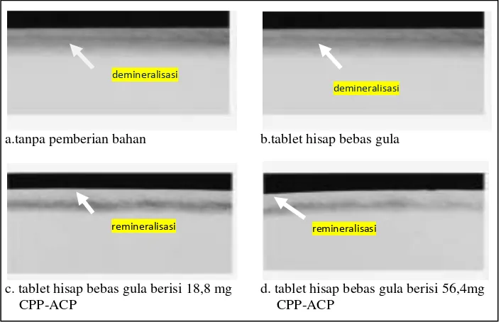 Gambar 2.5. Gambaran mikroradiograf menunjukkan remineralisasi lesi subsurface email dengan tablet hisap bebas gula yang berisi CPP-ACP (Cai et.al., 2009) 