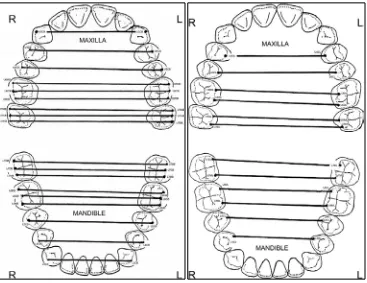 Gambar 3. Pengukuran lebar lengkung gigi menurut Ling dan Wong.26  