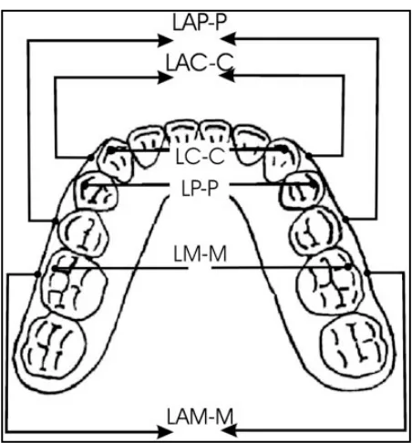 Gambar 4. Pengukuran lebar lengkung gigi rahang bawah menurut Uysal.8  