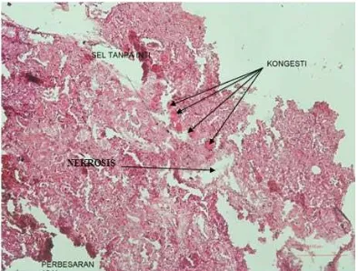 Gambar 2. Struktur Histopatologi Ginjal pada Konsentrasi 56 ml/L (Hemoragi pada ginjal, nekrosis pada tubulus  dan glomerulus ginjal, kongesti pada pembuluh darah ginjal  
