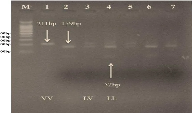 Figure (3): The digestion of PCR products (211) of GH gene with AluI enzyme. The product was electrophoresis on 3% agarose gel at 5 volt/cm2 for 1.5 hour, Visualized under U.V light after stain with Ethidium Bromide