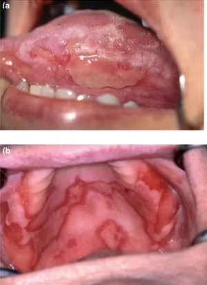 Gambar  1.  Ulkus  yang  disebabkan  karena obat (a) lidah (b) palatum  Xerostomia 