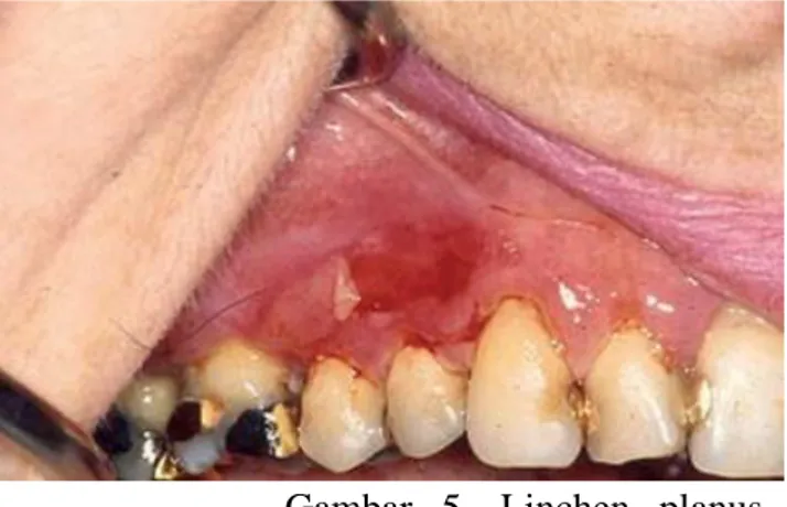 Gambar  5.  Linchen  planus  menunjukkan  ulkus  dikelilingi  striae  putih  pada  permukaan  ventral  lidah  (a)  dan  kemerahan  pada  mukosa  bukal 