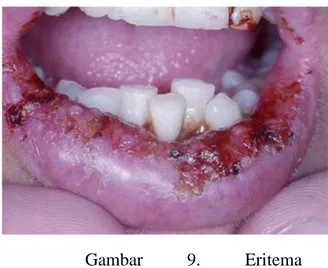 Gambar  9.  Eritema  multiforme  dengan  perdarahan  yang  luas,  ulserasi  dan  pengerasan  kulit  bibir bawah