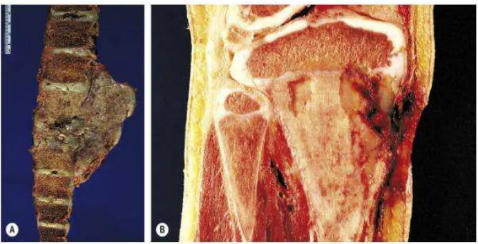 Gambar 2.7. A&B, Gambaran makroskopis lain dari osteosarkoma. (A0 Tumor ekstensif melibatkan tulang belakang dan menghasilkan massa jaringan lunak yang besar