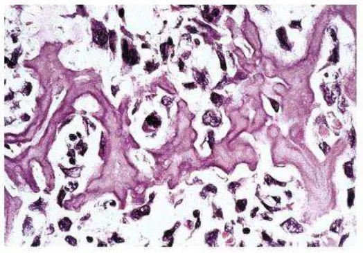 Gambar 2.8.  Osteosarkoma. Tulang yang malignant lebih basofilik dan memiliki pinggir yang irregular daripada trabekula tulang normal