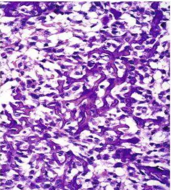 Gambar 2.10.  Gambaran mikroskopis osteosarkoma yang menunjukkan 