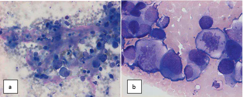 Gambar 2.13. Osteosarkoma kondroblastik. MGG, pembesaran sedang; Tampak sel-sel tumor yang atipik, besar yang tertanam pada matrik kondroid