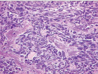 Gambar 2.21. Osteosarkoma fibroblastik terdiri dari sel-sel spindle yang malignan diantara deposit dari tulang yang neoplastik.17 