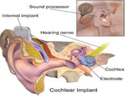 Gambar 3. 7 Ilustrasi Cochlear Implant 
