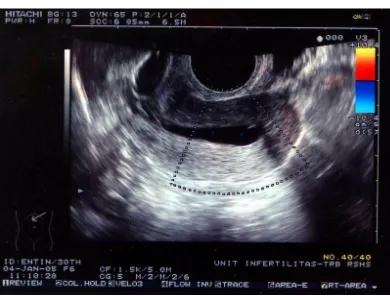 Gambar 1. Kavum uteri normal yang terlihat dengan prosedur SIS