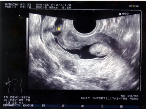 Gambar 2. Polip endometrium