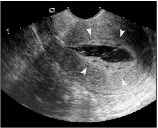Gambar 4. Hiperplasia endometrium. Dengan SIS tampak penebalan endometrium disertai beberapa daerah kistik fokal