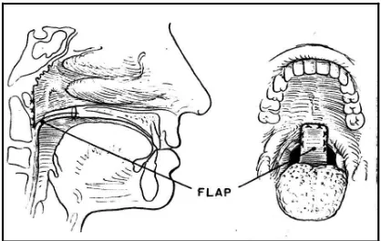 Gambar 6. Flep velofaringeal untuk mengoreksi insufisiensi velofaringeal; dasar 