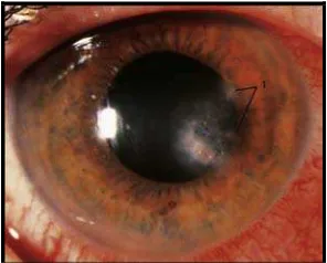 Gambar 3. Keratitis fungal dengan lesi satelit  