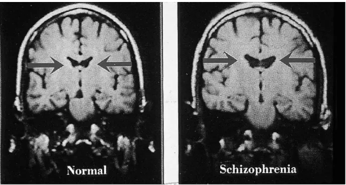 Gambar 2.1. Pembesaran ventrikel otak pada pasien skizofrenik (Stefan dkk., 2002) 