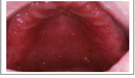 Gambar  5. Hiperplasia Papila dengan Eritema Difus 
