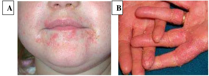 Gambar 2. Gambaran dermatitis kontak iritan disekitar mulut  (A) dan tangan (B) 14 