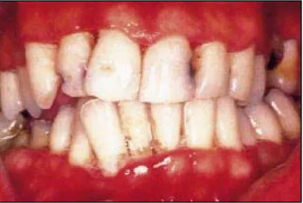 Gambar 6. Stain warna hitam pada servikal gigi anterior mandibular7 