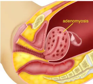 Gambar 4.1 Tampilan samping menunjukkan adenomiosis yang melibatkan seluruh uterus